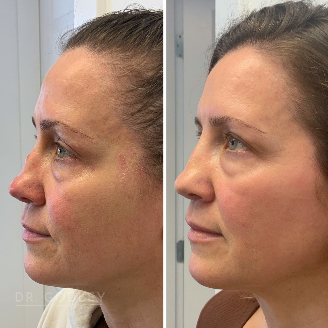 Non-Surgical Nose Job