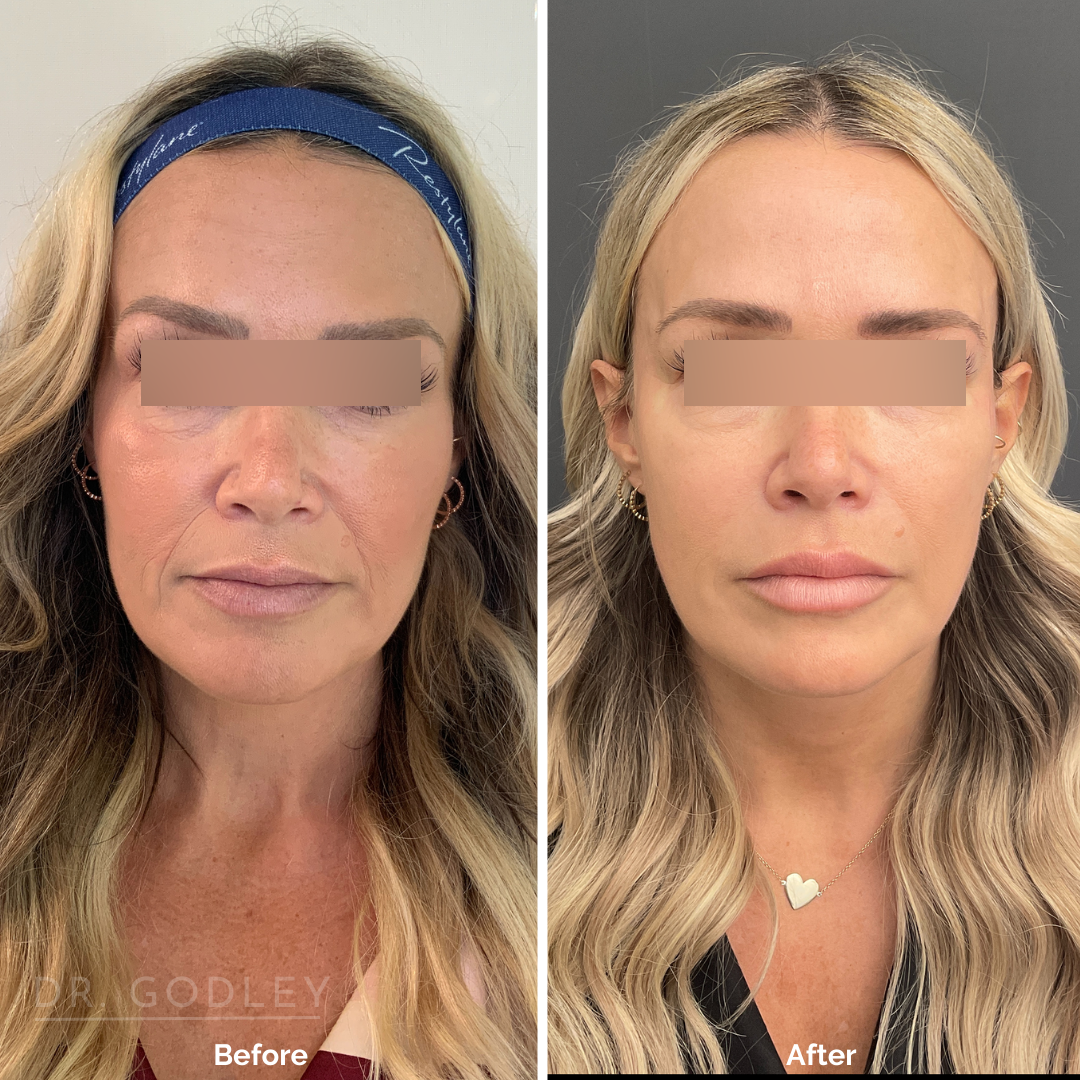 Non-surgical Face Lift