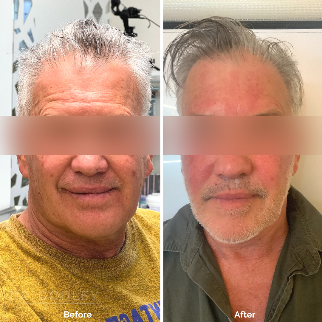 Non-surgical Face Lift