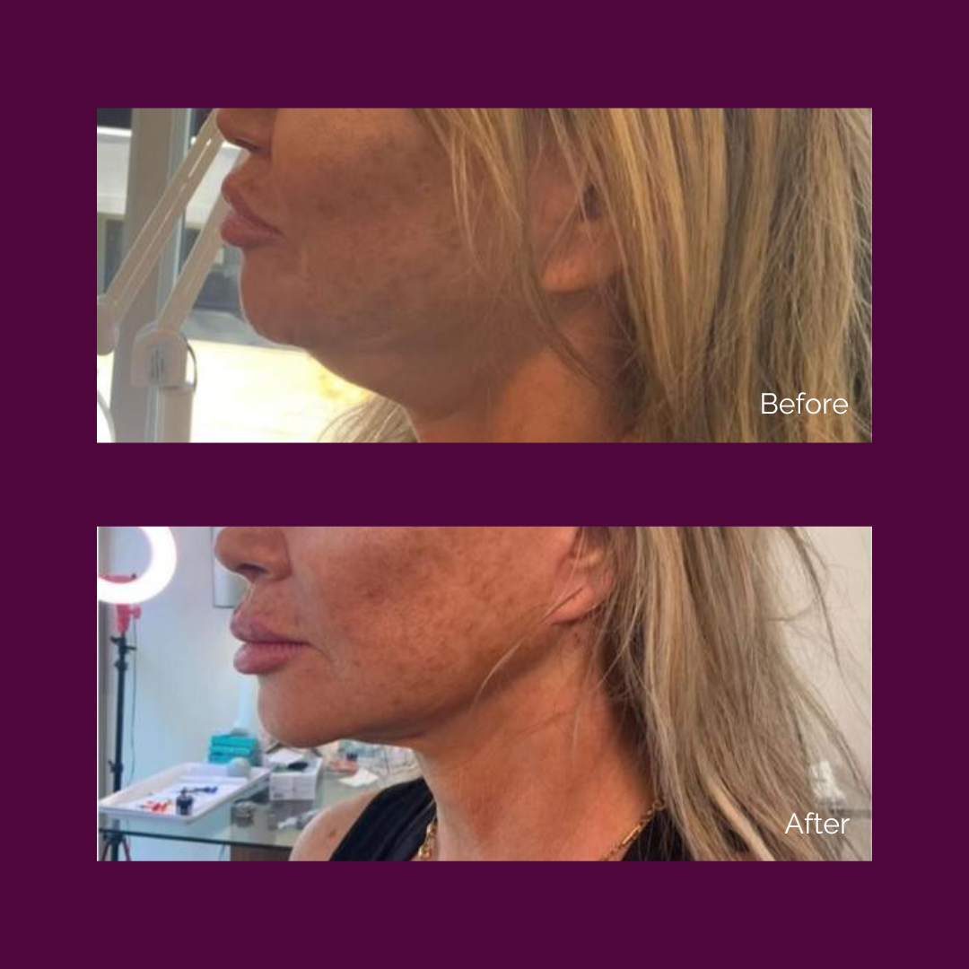 Non-surgical Face Lift