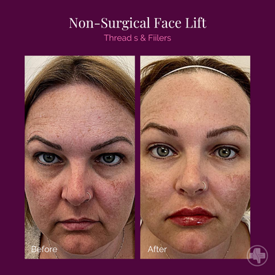 Non-surgical Face Lift