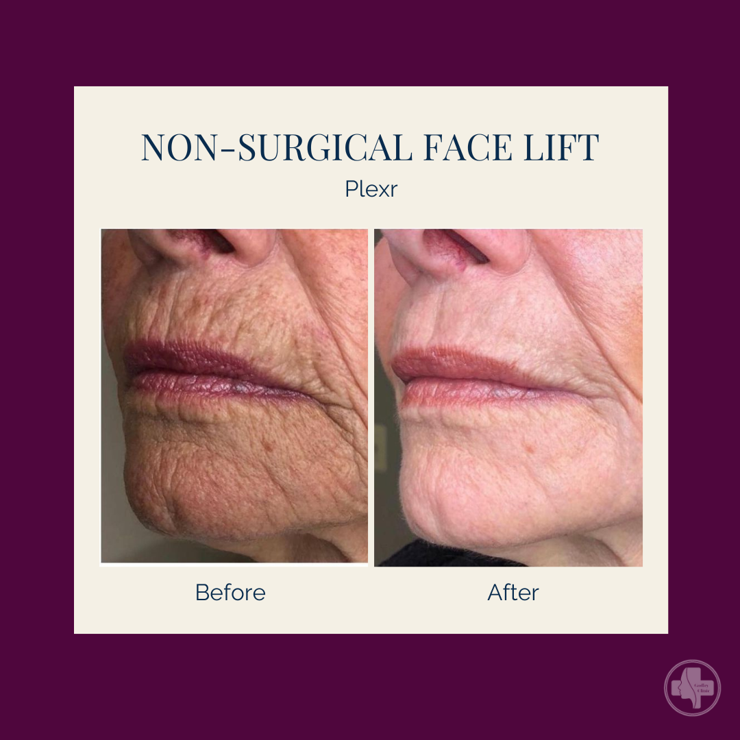 Non-surgical Face Lift