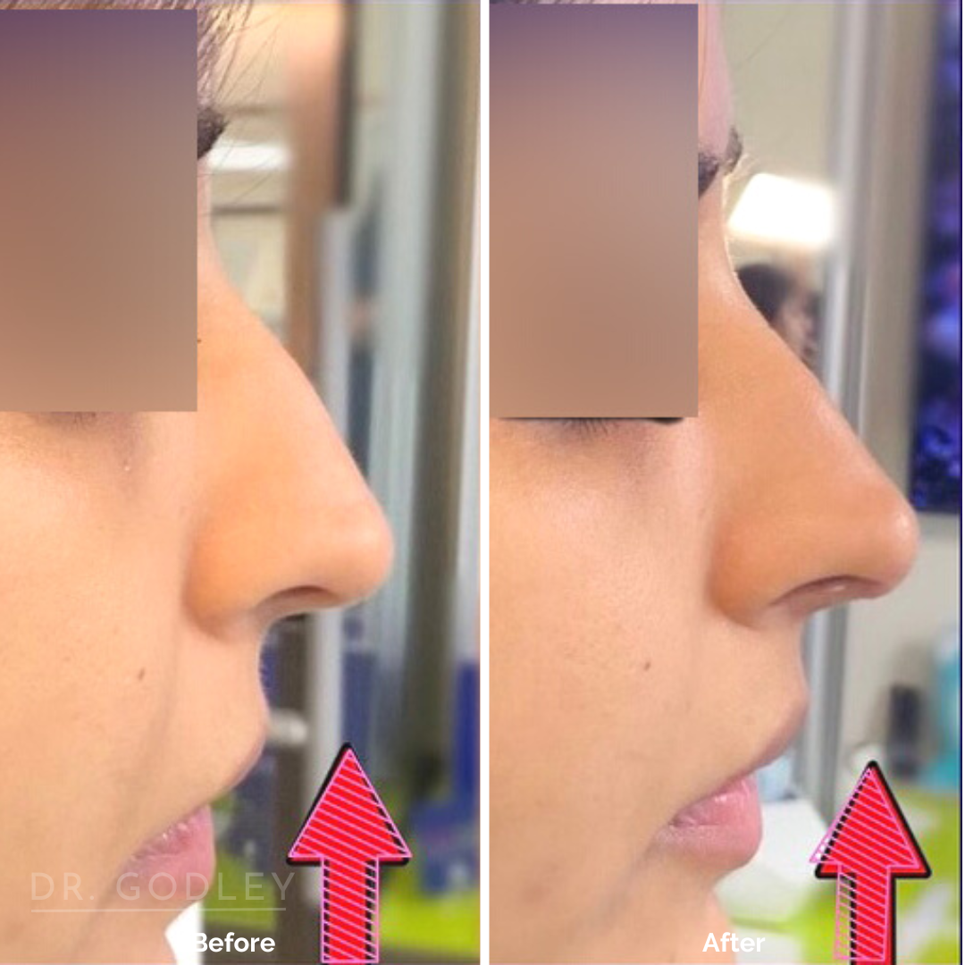 Non-Surgical Nose Job