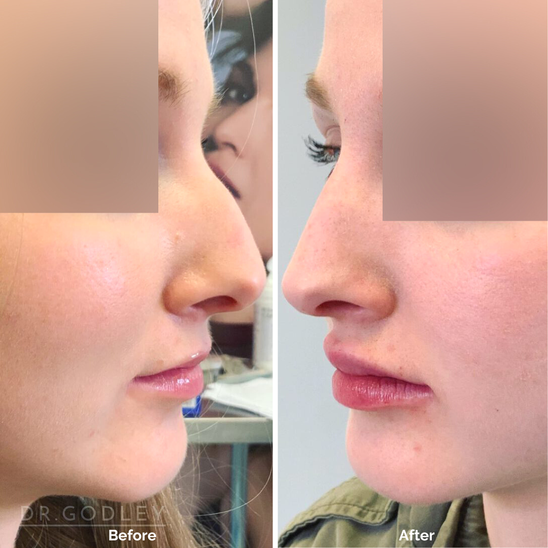 Non-Surgical Nose Job