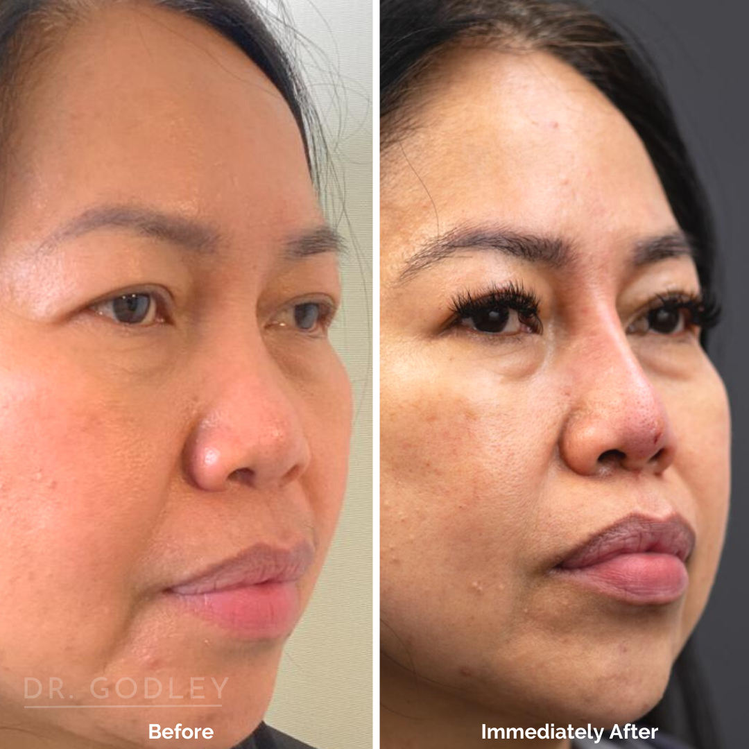 Non-Surgical Nose Job