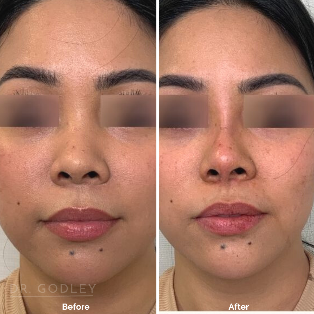 Non-Surgical Nose Job